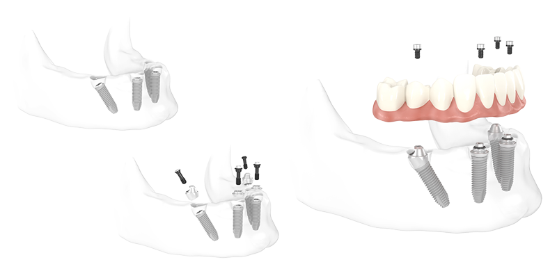 All-on-4: Grafik zeigt, wie die vier Implantate im Unterkiefer in Frontzahnbereich gesetzt werden, damit der neue Zahnersatz da verankert werden kann.